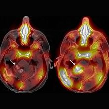 brain scan showing uptake of tratuzumab into tumor (arrow)